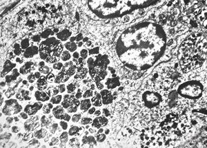 F,68y. | spleen - undefined myelinoid inclusions - clin. susp. leukemia F,68y. | spleen - undefined myelinoid inclusions - clin. susp. leukemia
